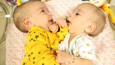 Photo of Rođene u razorenom Idlibu: Razdvajanje sijamskih blizanaca u turskoj bolnici potrajat će dvije godine