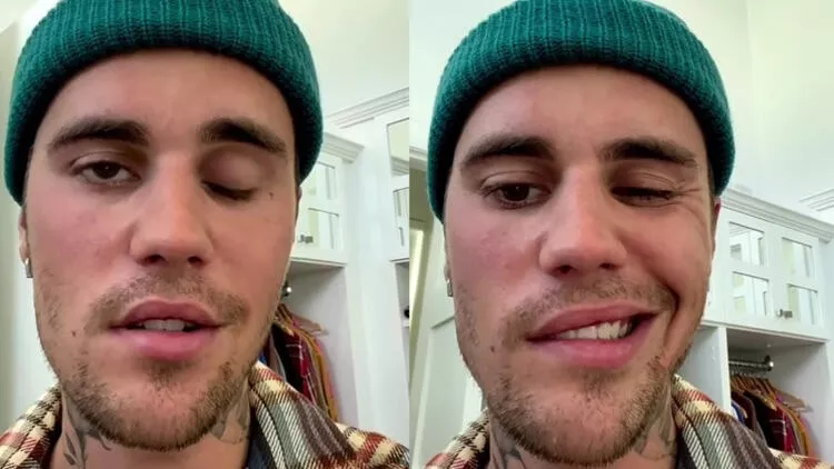 Justin Bieber doživio djelimičnu paralizu lica